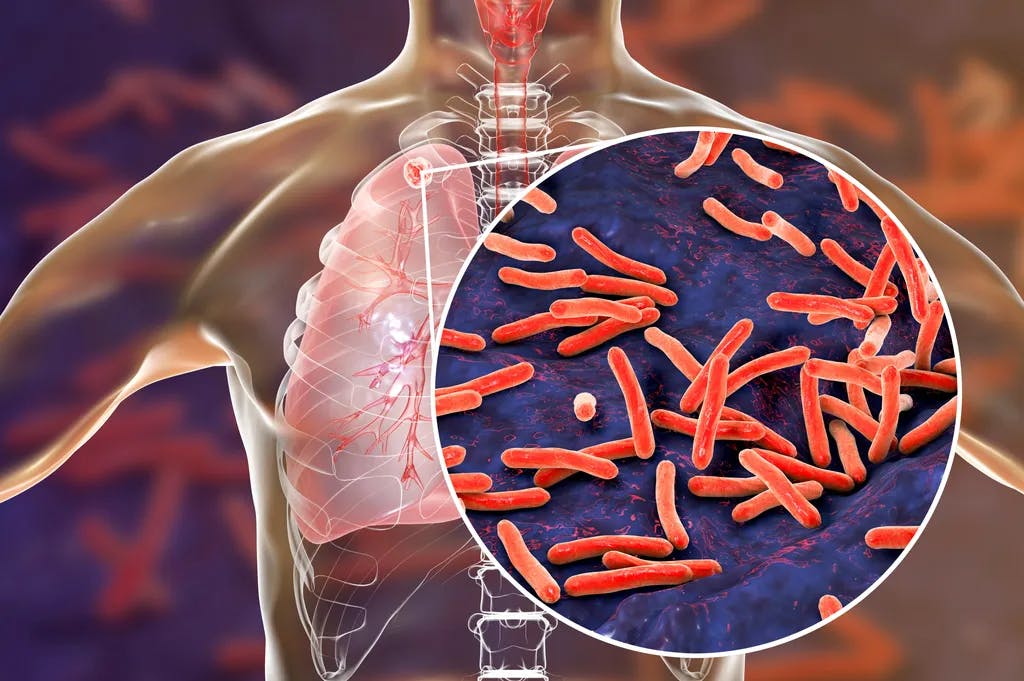 Sekundäre Tuberkulose in der Lunge und Nahaufnahme von Mycobacterium tuberculosis bacteria, 3D-Illustration